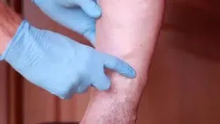 Varicose Veins