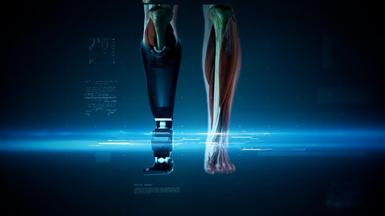 Surgical Type Below Knee Legs Prosthesis, For Medical, Prostheses Leg