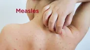 Measles | Line One: Your Health Connection