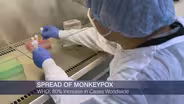 CDC Confirms 62 Cases of Monkeypox in Illinois