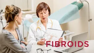 Fibroids