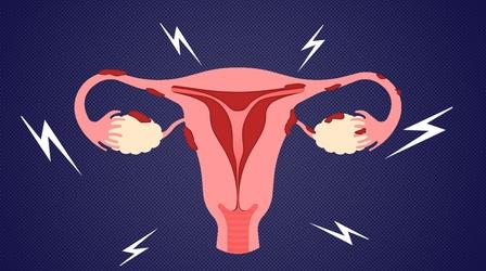 Video thumbnail: Vitals Why Endometriosis Patients Keep Getting Gaslit