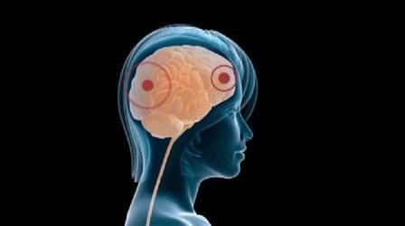 Video thumbnail: Concussions and Female Athletes Signs, Symptoms & Specifics