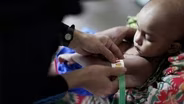 Malnutrition, a silent epidemic