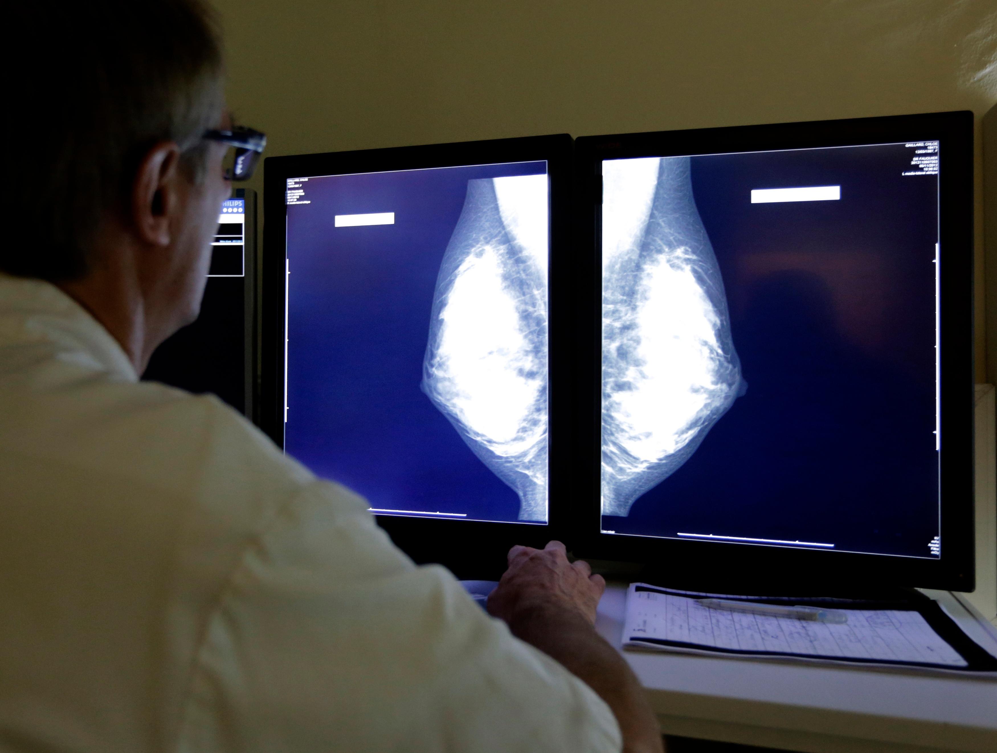 Study raises questions about early breast cancer treatment