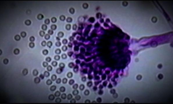 Tainted Steroid Drugs Caused Deadly Meningitis Outbreak