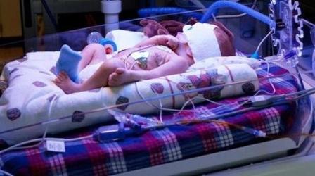 Video thumbnail: PBS NewsHour New Scan Improves Diagnosing Genetic Diseases in Newborns