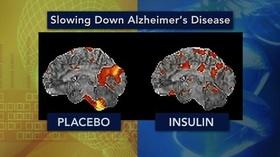 Video thumbnail: PBS NewsHour Insulin Spritz Shows Promise for People With Early Signs...