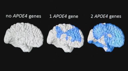 Video thumbnail: NOVA Predicting Alzheimer’s