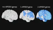 Predicting Alzheimer’s