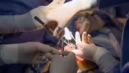Preview of Spina Bifida Surgery
