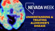 Understanding & Treating Alzheimer’s Disease