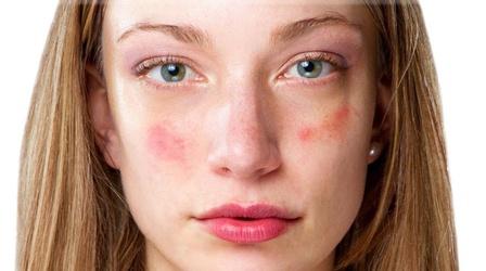 Video thumbnail: Line One: Your Health Connection Treatment tips and prevention for acne