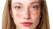 Treatment tips and prevention for acne