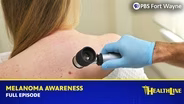 Melanoma Awareness: Prevention, Detection & Treatment