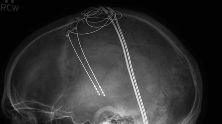 Video thumbnail: The Mayo Clinic Present-Day Patient: Roger Frisch, Minneapolis, MN