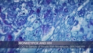 CDC Report Studies Monkeypox and HIV Infection Rates