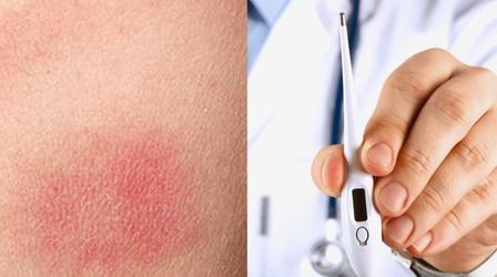 Video thumbnail: Headline Symptoms of Tick-Borne Illness