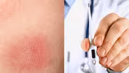 Symptoms of Tick-Borne Illness