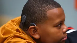 Louisville Boy First in U.S. to Receive New Cochlear Implant Technology