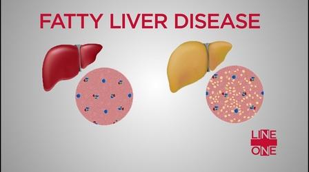 Video thumbnail: Line One: Your Health Connection Fatty Liver Disease