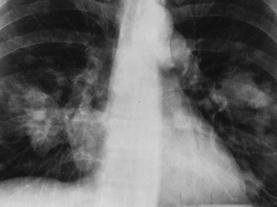 Cuba’s Inventive Vaccine Could Treat More Than Just Lung Cancer