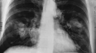 Cuba’s Inventive Vaccine Could Treat More Than Just Lung Cancer
