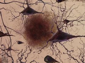 Glimmers of Hope Before an Alzheimer’s Epidemic